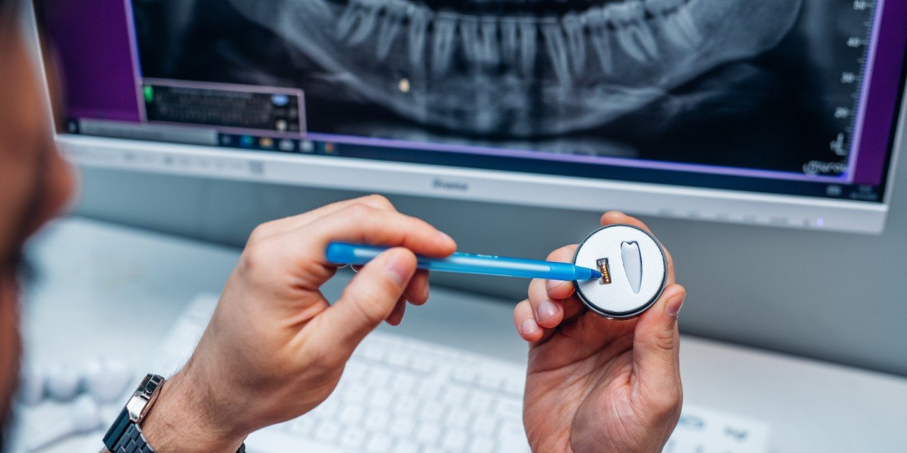 Implanty zębowe w Polsce: osoby 50+ doceniają zalety, hamują ich koszty