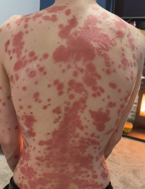 EXCLUSIVE: GP Dr Donald Grant, Trichologist Tony Maleedy and Dermatoligst Dr Eva Melegh on Psoriasis Awareness Month